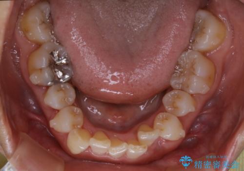 下の前歯が見えない:深い噛み合わせもインビザラインでの治療中