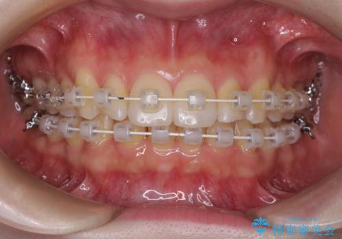 インビザラインを断念 ワイヤー装置で楽々と矯正治療の治療中