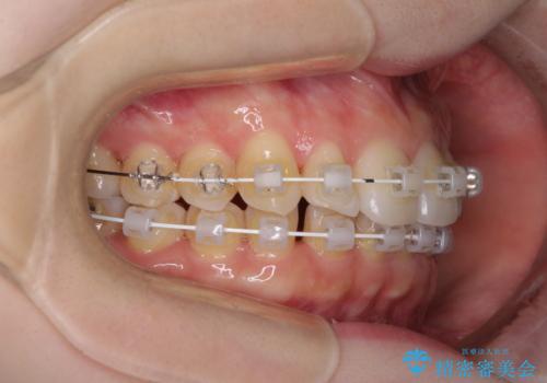 インビザラインを断念 ワイヤー装置で楽々と矯正治療の治療中
