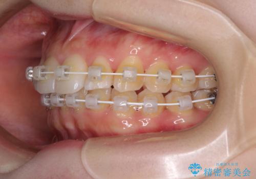 インビザラインを断念 ワイヤー装置で楽々と矯正治療の治療中