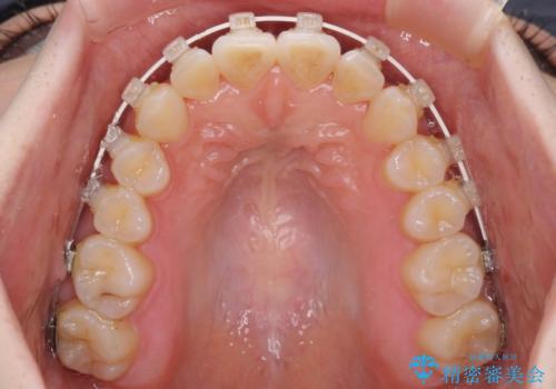 インビザラインを断念 ワイヤー装置で楽々と矯正治療の治療中