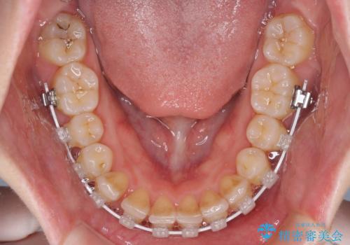 インビザラインを断念 ワイヤー装置で楽々と矯正治療の治療中