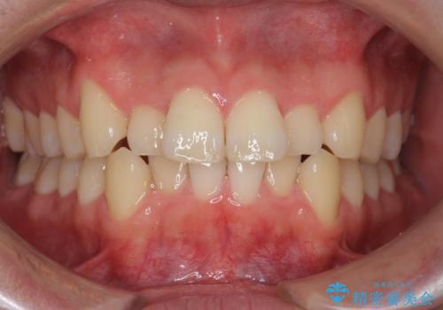 前歯のがたつき　マウスピース矯正で　非抜歯で奥歯を後ろに下げる治療の治療前