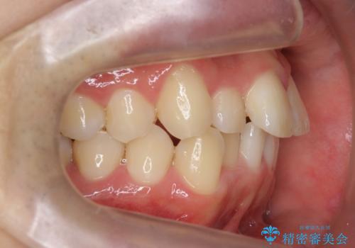 前歯のがたつき　マウスピース矯正で　非抜歯で奥歯を後ろに下げる治療の治療前