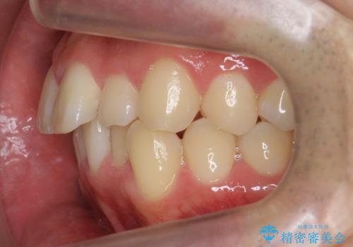 前歯のがたつき マウスピース矯正で 非抜歯で奥歯を後ろに下げる治療の治療前