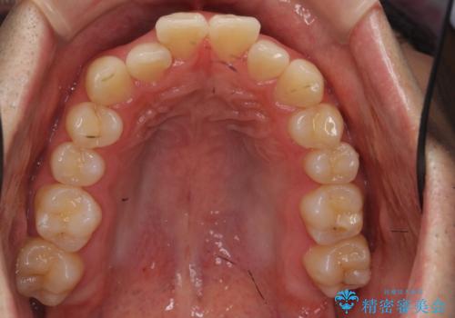 前歯のがたつき マウスピース矯正で 非抜歯で奥歯を後ろに下げる治療の治療前