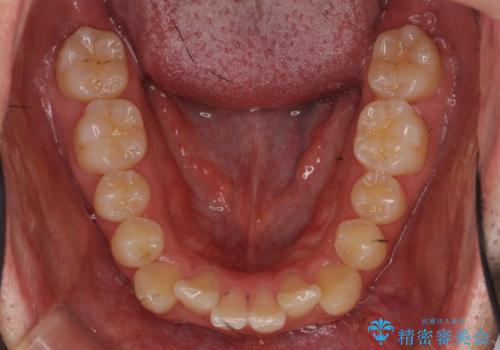 前歯のがたつき マウスピース矯正で 非抜歯で奥歯を後ろに下げる治療の治療前
