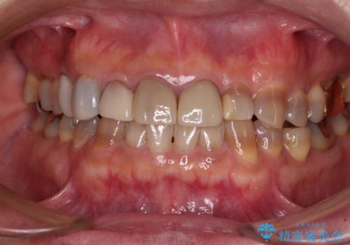 テトラサイクリン歯をオールセラミッククラウンで審美的にの治療前