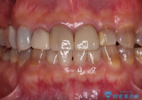 テトラサイクリン歯をオールセラミッククラウンで審美的にの治療前