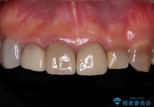 テトラサイクリン歯をオールセラミッククラウンで審美的にの症例 治療前