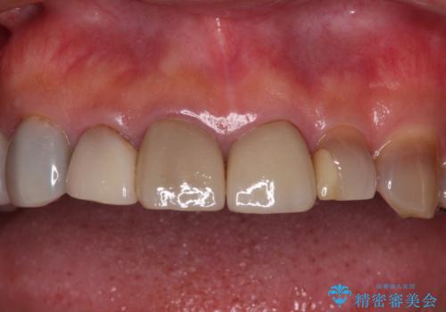 テトラサイクリン歯をオールセラミッククラウンで審美的にの治療前