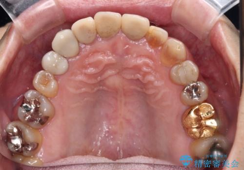 テトラサイクリン歯をオールセラミッククラウンで審美的にの治療前