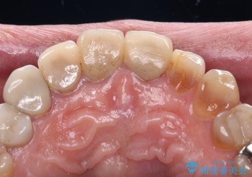 テトラサイクリン歯をオールセラミッククラウンで審美的にの治療前