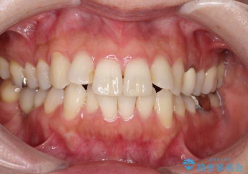 大人の目立たない矯正 インビザラインの症例 治療前