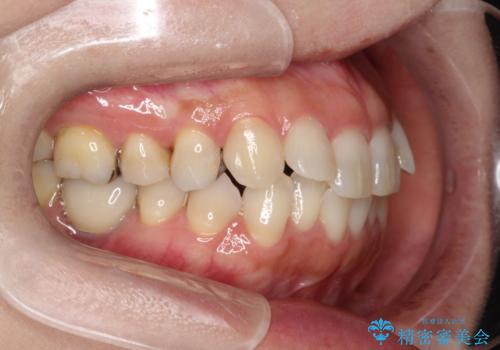 大人の目立たない矯正 インビザラインの治療前