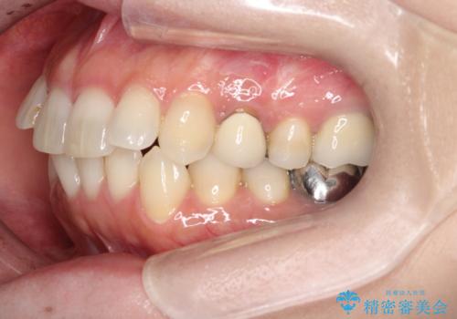 大人の目立たない矯正 インビザラインの治療前