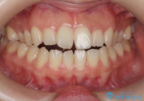 オフィスホワイトニングで、歯を白く!の治療前