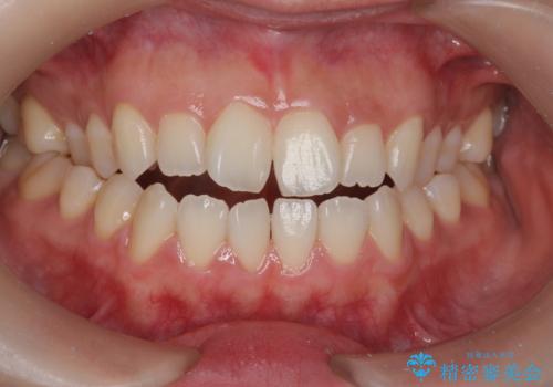 オフィスホワイトニングで、歯を白く!の治療後