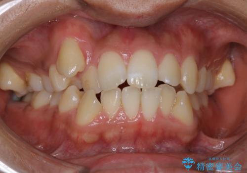 オーディションで歯並びを指摘された:自信をもって歌える口元へ