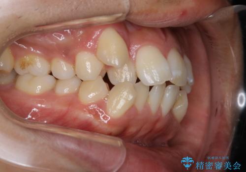 オーディションで歯並びを指摘された:自信をもって歌える口元への治療前