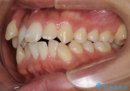 オーディションで歯並びを指摘された:自信をもって歌える口元への治療前