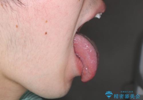 滑舌が気になる:矯正治療前に舌小帯切除の治療後