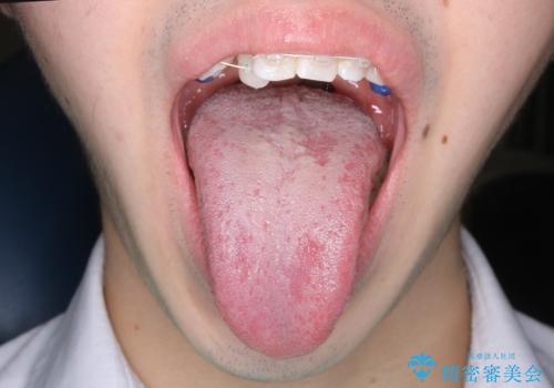 滑舌が気になる:矯正治療前に舌小帯切除の治療後