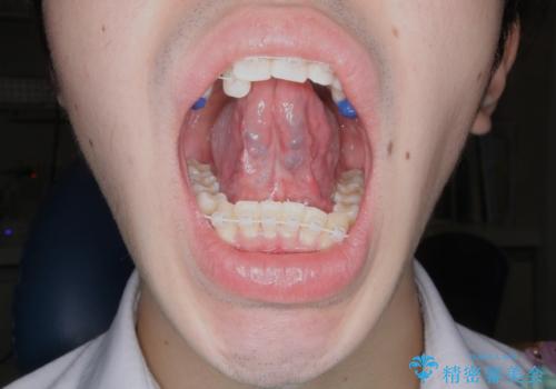 滑舌が気になる:矯正治療前に舌小帯切除の治療後