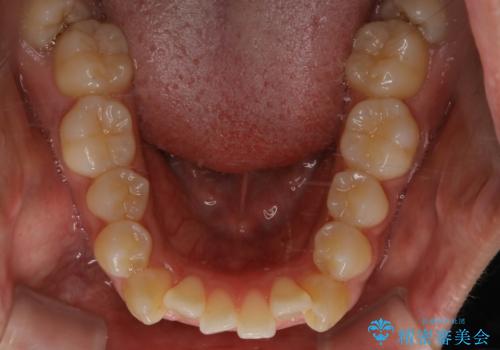 オーディションで歯並びを指摘された:自信をもって歌える口元への治療前