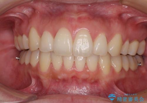 再矯正で突出した口元を引っ込める 抜歯矯正の後戻りの治療中