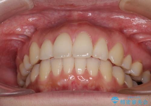 再矯正で突出した口元を引っ込める　抜歯矯正の後戻りの治療中