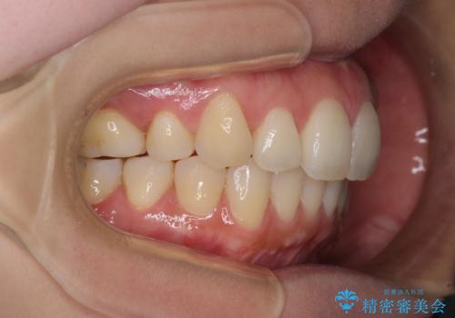 再矯正で突出した口元を引っ込める　抜歯矯正の後戻りの治療中