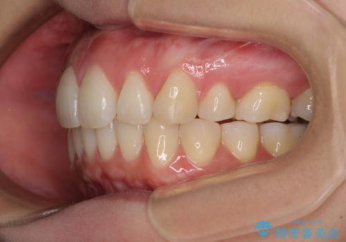 再矯正で突出した口元を引っ込める 抜歯矯正の後戻りの治療中