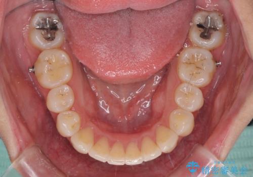 再矯正で突出した口元を引っ込める 抜歯矯正の後戻りの治療中