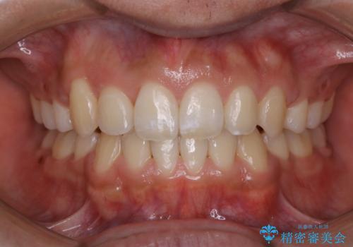 オーディションで歯並びを指摘された:自信をもって歌える口元への症例 治療後