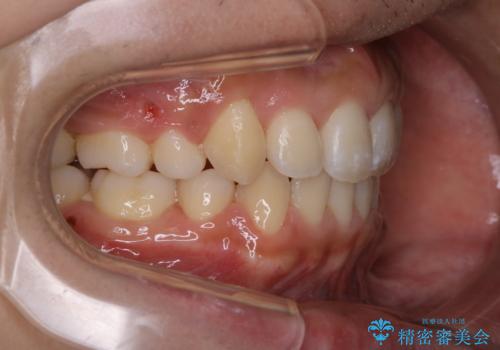 オーディションで歯並びを指摘された:自信をもって歌える口元への治療後