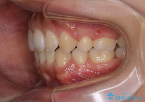 オーディションで歯並びを指摘された:自信をもって歌える口元への治療後