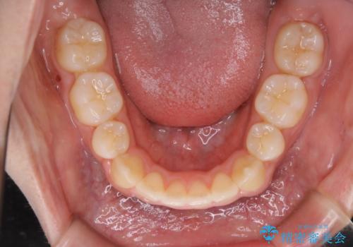 オーディションで歯並びを指摘された:自信をもって歌える口元への治療後