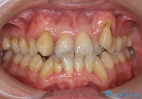 オフィスホワイトニングで、歯を白く口元イメージアップで爽やかに!!の治療前