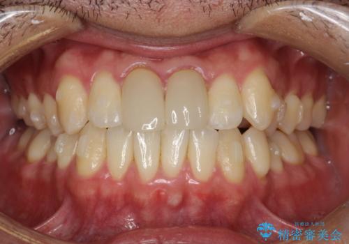 上下のがたつきをインビザラインで目立たない矯正の治療中