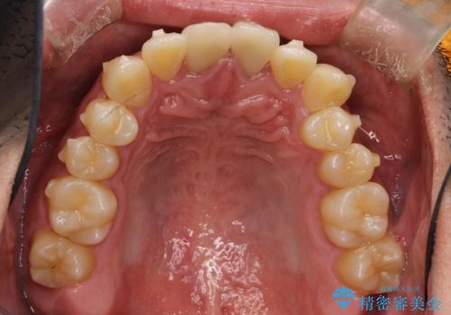 上下のがたつきをインビザラインで目立たない矯正の治療中