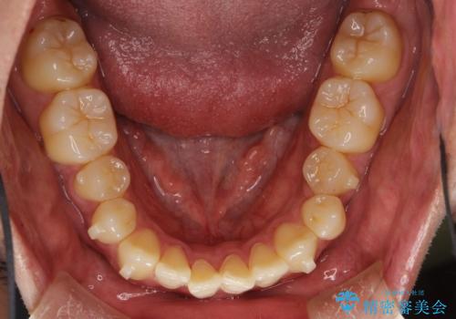 上下のがたつきをインビザラインで目立たない矯正の治療中