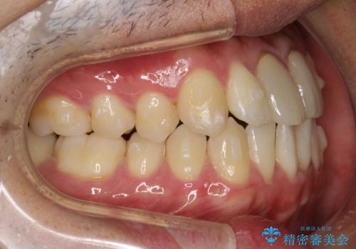 上下のがたつきをインビザラインで目立たない矯正の治療中