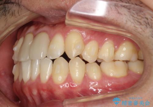 上下のがたつきをインビザラインで目立たない矯正の治療中