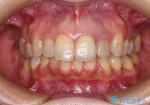 横から見た時の歯の色が違いすぎる 前歯のオールセラミッククラウンの治療前