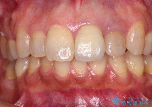 横から見た時の歯の色が違いすぎる　前歯のオールセラミッククラウンの治療前