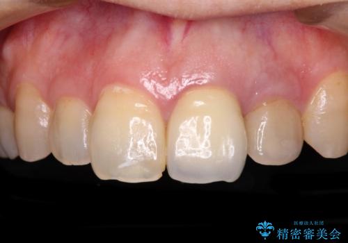 横から見た時の歯の色が違いすぎる　前歯のオールセラミッククラウンの症例 治療前