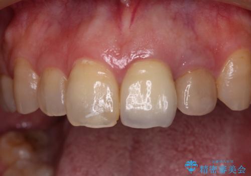 横から見た時の歯の色が違いすぎる 前歯のオールセラミッククラウンの治療前