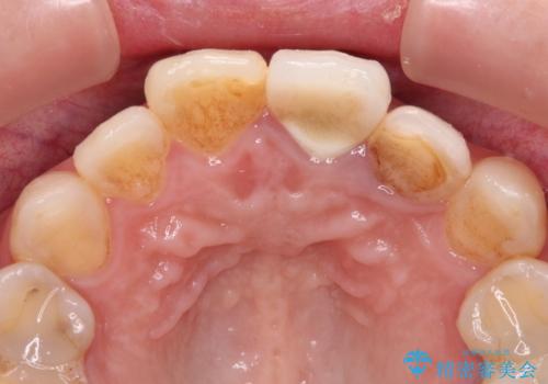 横から見た時の歯の色が違いすぎる 前歯のオールセラミッククラウンの治療前