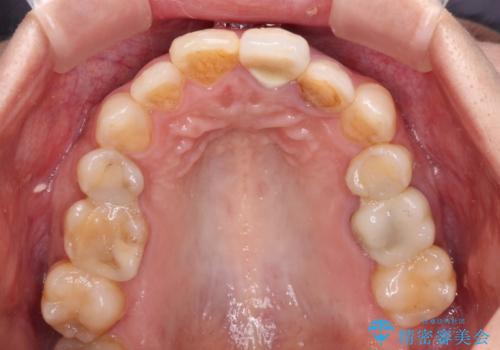 横から見た時の歯の色が違いすぎる　前歯のオールセラミッククラウンの治療前